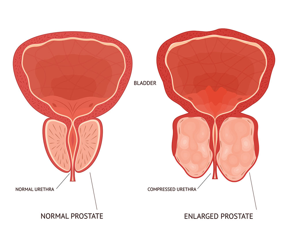 how to reduce prostate enlargement naturally